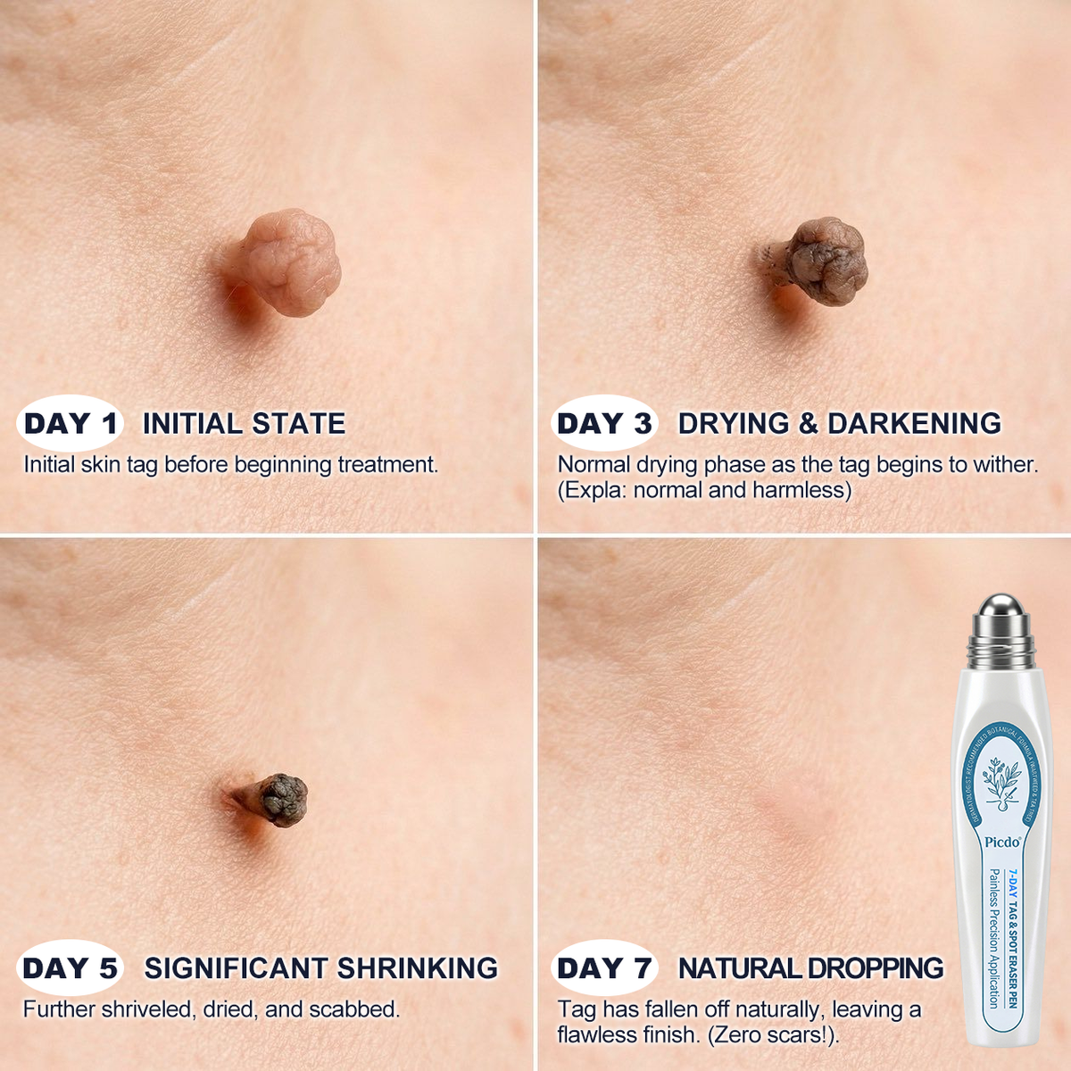 7-𝐷𝑎𝑦 𝗧𝐚𝐠 & 𝗦𝗽𝐨𝐭 𝐄𝐫𝒂𝒔𝒆𝒓(Zero Pain, Zero 𝐒𝐜𝐚𝒓𝒔 Rollerball)🌿